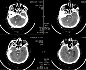 术后7天，血肿基本引流干净
