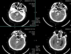 术后复查，显示定位准确，穿刺道完全符合术前计划